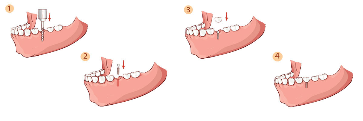 Florence Dental Implant Restoration
