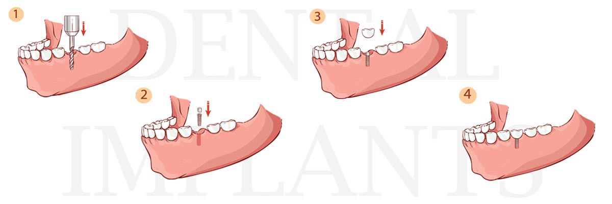 Florence The Difference Between Dental Implants and Mini Dental Implants