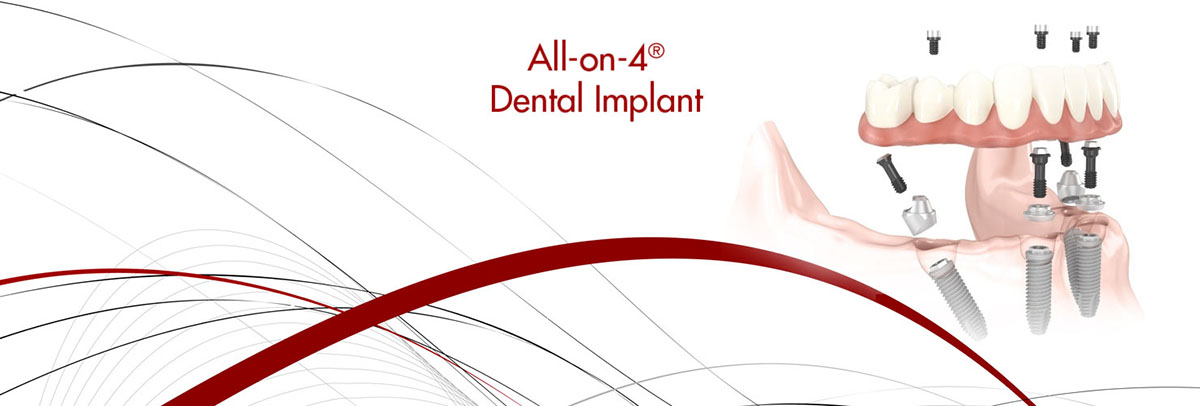 Florence All-on-4 Dental Implants