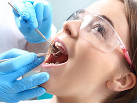 dental fillings