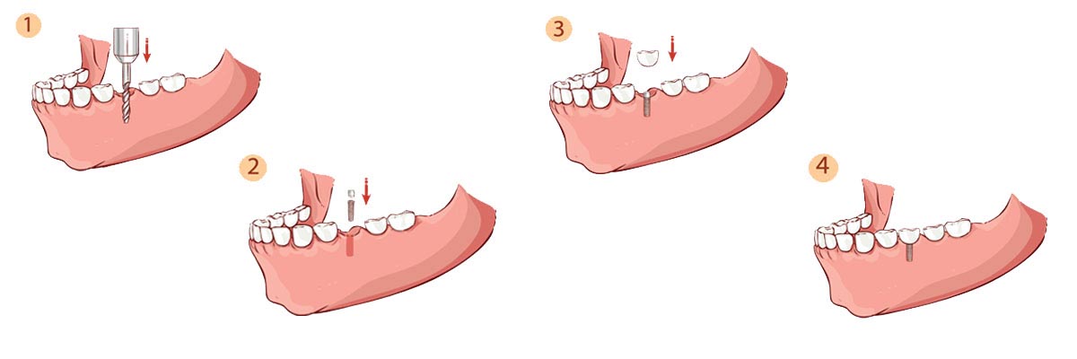 Florence The Dental Implant Procedure