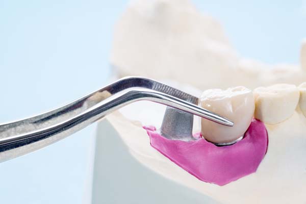 Dental Implant Restoration Florence, KY