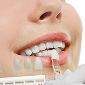 Dental Veneers