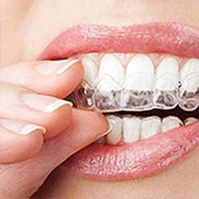 invisalign-dentist