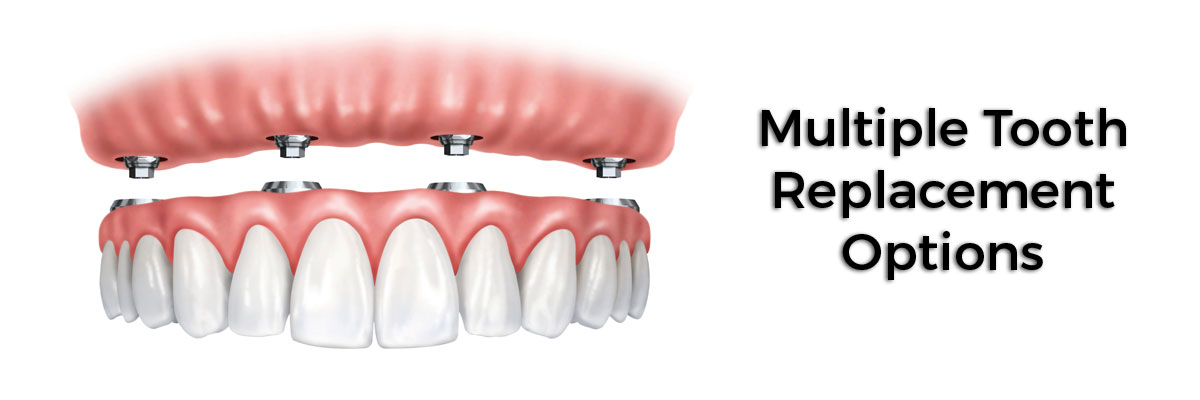 Florence Multiple Teeth Replacement Options