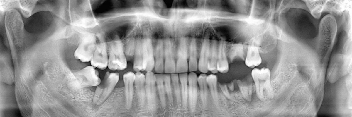 Florence Options for Replacing Missing Teeth